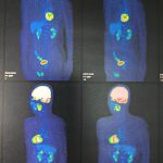 PET-CTがんドックの結果から分かったこと