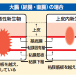 保険の支払われない癌がある？ ～ がん保険を見直そう