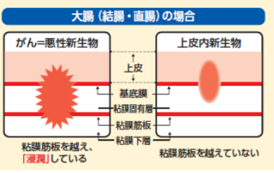 と は 生物 上皮 内 新 上皮内新生物と悪性新生物の違いは？