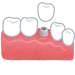 インプラント利用を決める