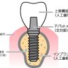 ［とにかく痛い］インプラント検討から完了までの感想