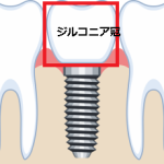 1年後にインプラントがポロリ